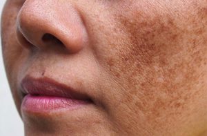 Nám da và cách điều trị tại nhà