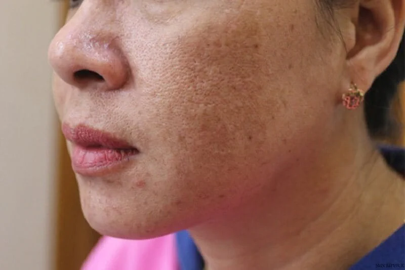 Nám mảng là gì?