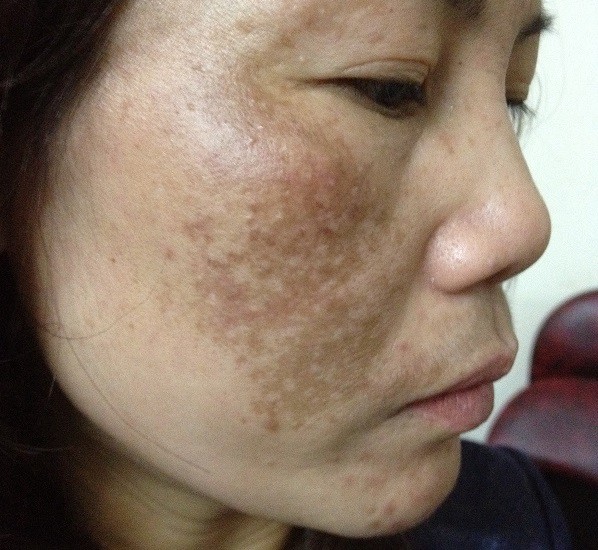 Đối với những trường hợp nám nặng hoặc lâu năm, bạn nên tham khảo ý kiến từ các chuyên gia da liễu