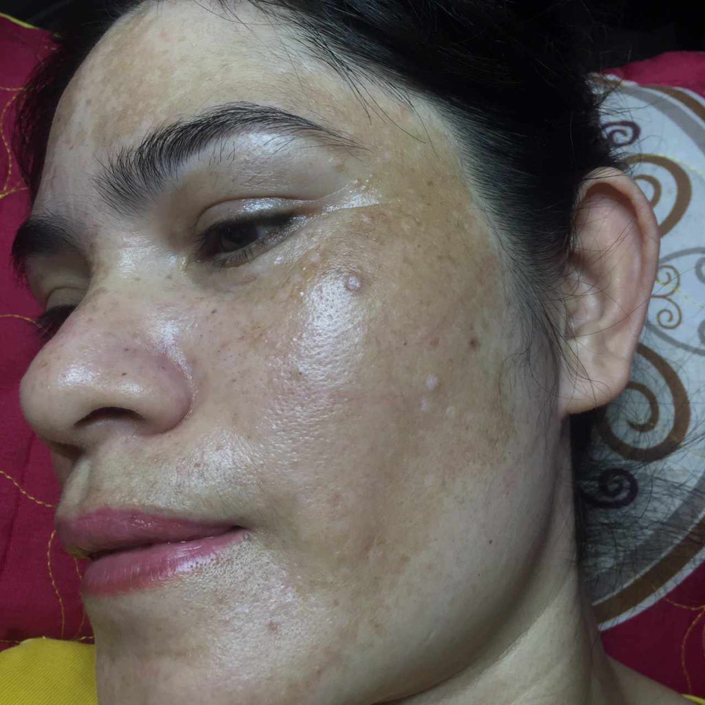 Có rất nhiều nguyên nhân dẫn đến tình trạng đốm nâu trên da