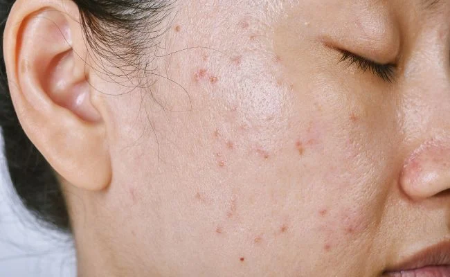 Da bị mụn thiếu chất gì ?