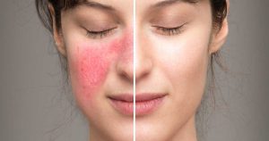 Tăng sắc tố sau laser