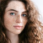 Nám cánh bướm (Melasma) là tình trạng tăng sắc tố da, hình thành các mảng sậm màu đối xứng trên mặt