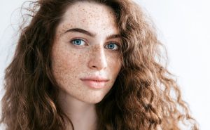 Nám cánh bướm (Melasma) là tình trạng tăng sắc tố da, hình thành các mảng sậm màu đối xứng trên mặt