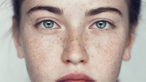 nám chân đinh là gì ?