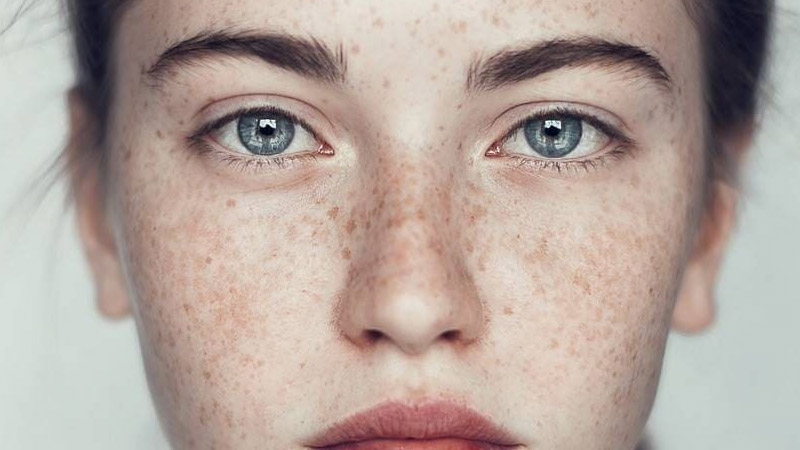 nám chân đinh là gì ?